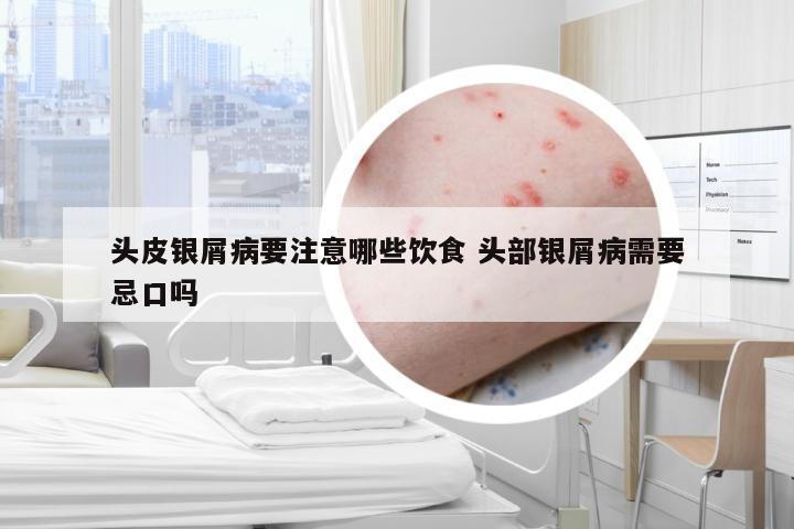 头皮银屑病要注意哪些饮食 头部银屑病需要忌口吗