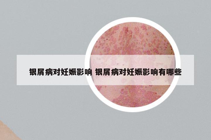 银屑病对妊娠影响 银屑病对妊娠影响有哪些