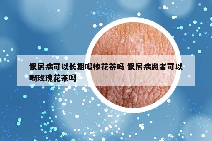 银屑病可以长期喝槐花茶吗 银屑病患者可以喝玫瑰花茶吗