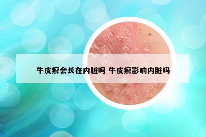 牛皮癣会长在内脏吗 牛皮癣影响内脏吗