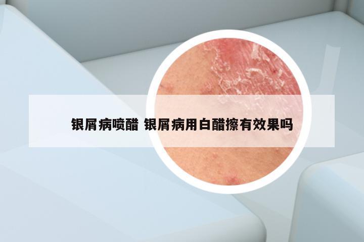 银屑病喷醋 银屑病用白醋擦有效果吗