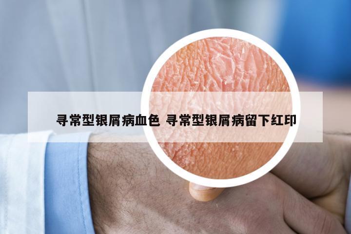 寻常型银屑病血色 寻常型银屑病留下红印