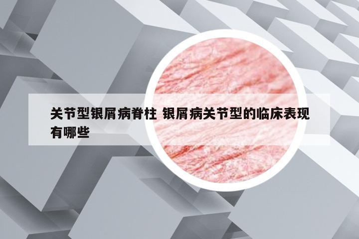 关节型银屑病脊柱 银屑病关节型的临床表现有哪些