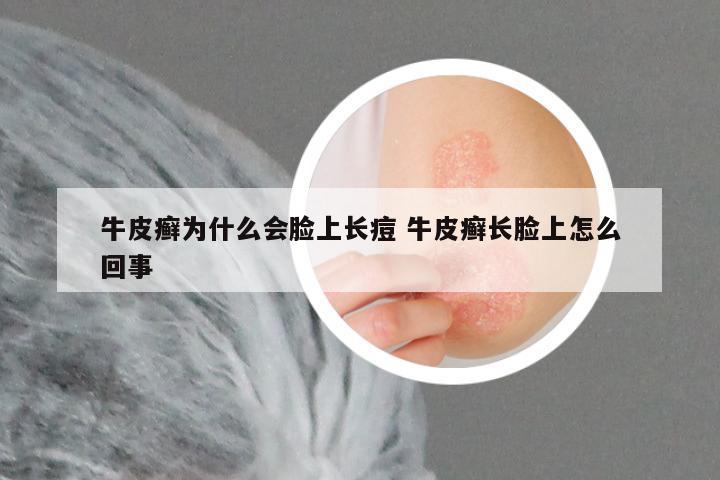 牛皮癣为什么会脸上长痘 牛皮癣长脸上怎么回事