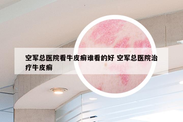 空军总医院看牛皮癣谁看的好 空军总医院治疗牛皮癣