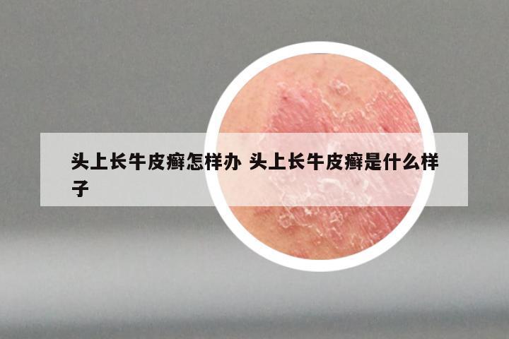 头上长牛皮癣怎样办 头上长牛皮癣是什么样子