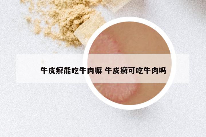 牛皮癣能吃牛肉嘛 牛皮癣可吃牛肉吗