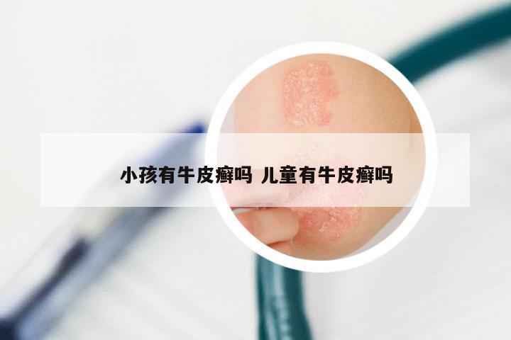 小孩有牛皮癣吗 儿童有牛皮癣吗