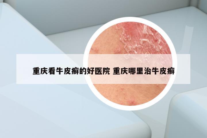重庆看牛皮癣的好医院 重庆哪里治牛皮癣