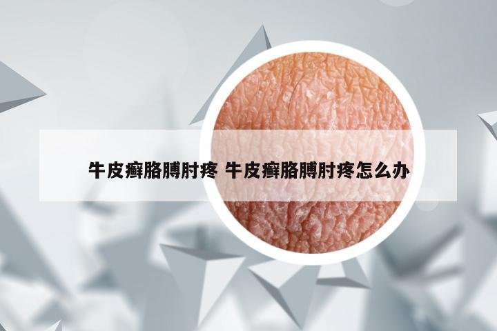 牛皮癣胳膊肘疼 牛皮癣胳膊肘疼怎么办