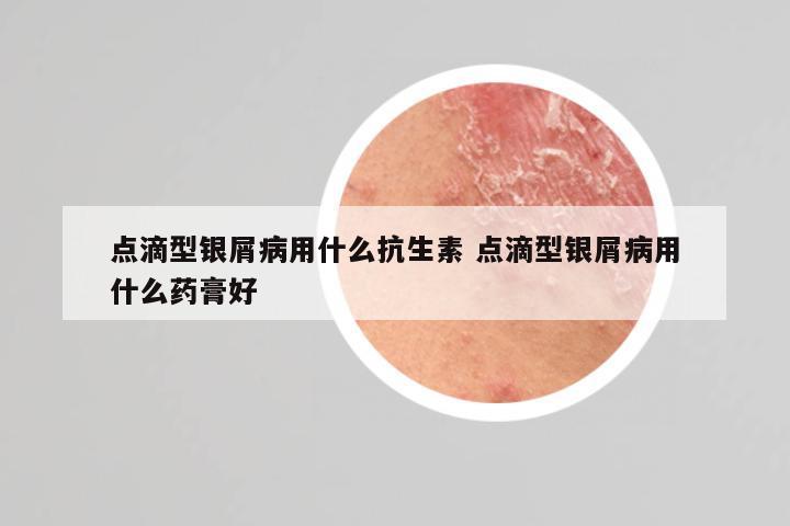 点滴型银屑病用什么抗生素 点滴型银屑病用什么药膏好