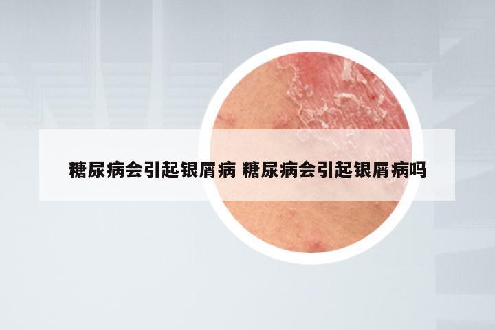 糖尿病会引起银屑病 糖尿病会引起银屑病吗