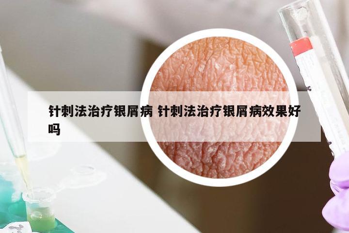 针刺法治疗银屑病 针刺法治疗银屑病效果好吗