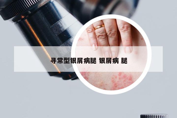 寻常型银屑病腿 银屑病 腿