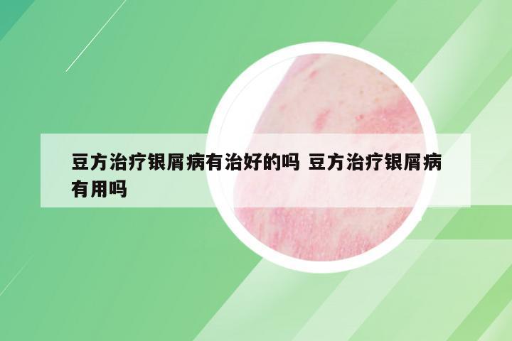 豆方治疗银屑病有治好的吗 豆方治疗银屑病有用吗