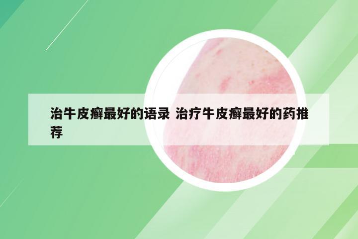 治牛皮癣最好的语录 治疗牛皮癣最好的药推荐