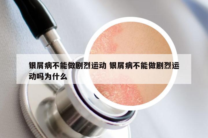 银屑病不能做剧烈运动 银屑病不能做剧烈运动吗为什么