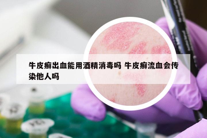 牛皮癣出血能用酒精消毒吗 牛皮癣流血会传染他人吗