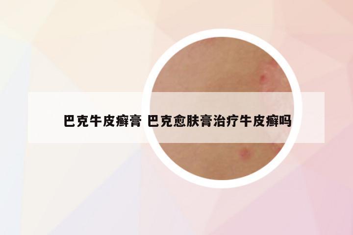 巴克牛皮癣膏 巴克愈肤膏治疗牛皮癣吗