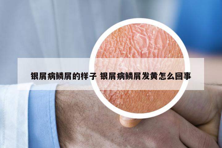 银屑病鳞屑的样子 银屑病鳞屑发黄怎么回事