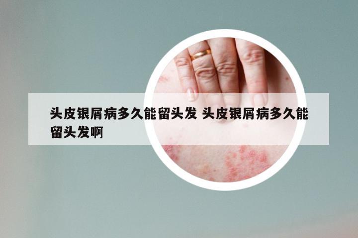 头皮银屑病多久能留头发 头皮银屑病多久能留头发啊