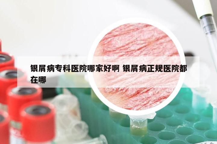银屑病专科医院哪家好啊 银屑病正规医院都在哪