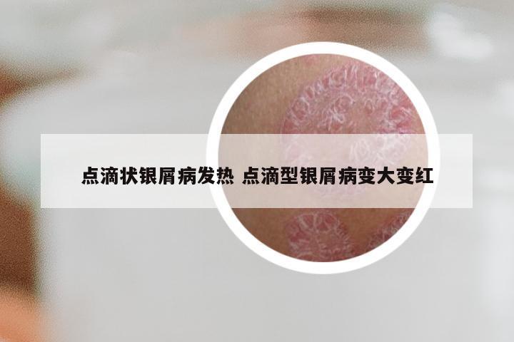 点滴状银屑病发热 点滴型银屑病变大变红