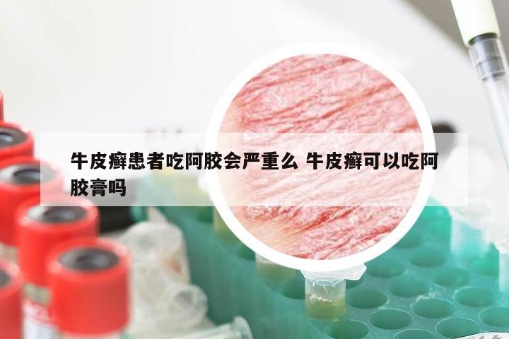 牛皮癣患者吃阿胶会严重么 牛皮癣可以吃阿胶膏吗