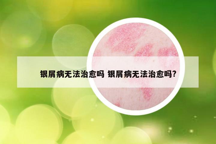 银屑病无法治愈吗 银屑病无法治愈吗?