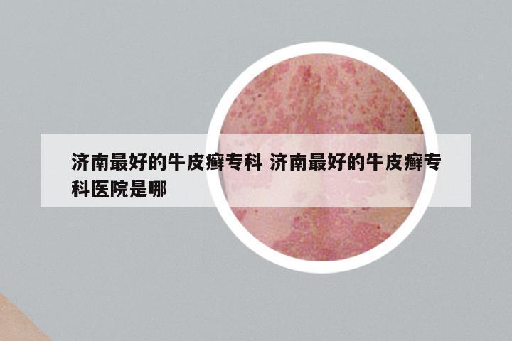 济南最好的牛皮癣专科 济南最好的牛皮癣专科医院是哪