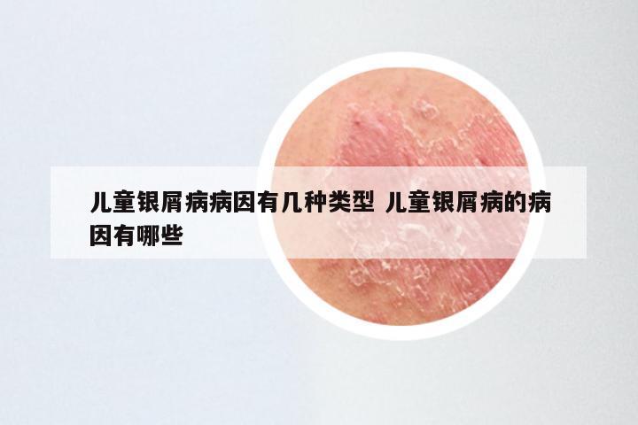 儿童银屑病病因有几种类型 儿童银屑病的病因有哪些