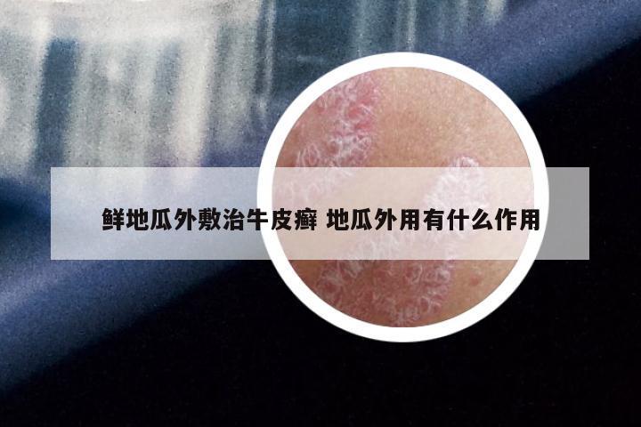 鲜地瓜外敷治牛皮癣 地瓜外用有什么作用