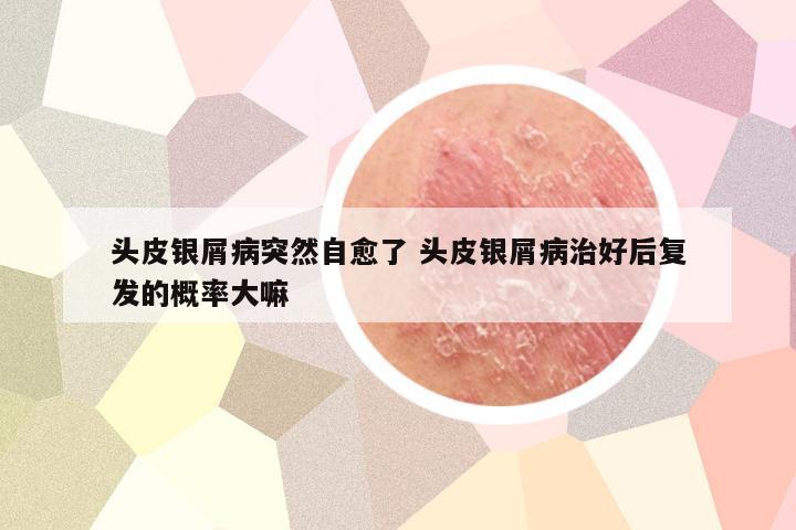 头皮银屑病突然自愈了 头皮银屑病治好后复发的概率大嘛