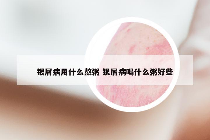 银屑病用什么熬粥 银屑病喝什么粥好些