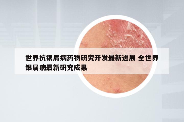 世界抗银屑病药物研究开发最新进展 全世界银屑病最新研究成果