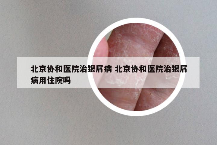 北京协和医院治银屑病 北京协和医院治银屑病用住院吗