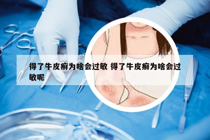 得了牛皮癣为啥会过敏 得了牛皮癣为啥会过敏呢