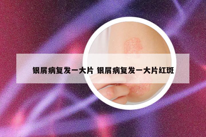 银屑病复发一大片 银屑病复发一大片红斑