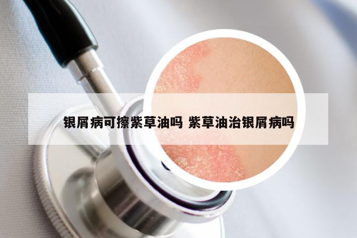 银屑病可擦紫草油吗 紫草油治银屑病吗