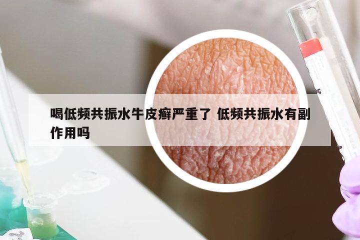 喝低频共振水牛皮癣严重了 低频共振水有副作用吗