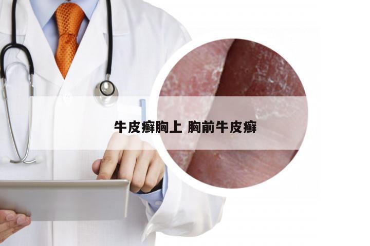 牛皮癣胸上 胸前牛皮癣