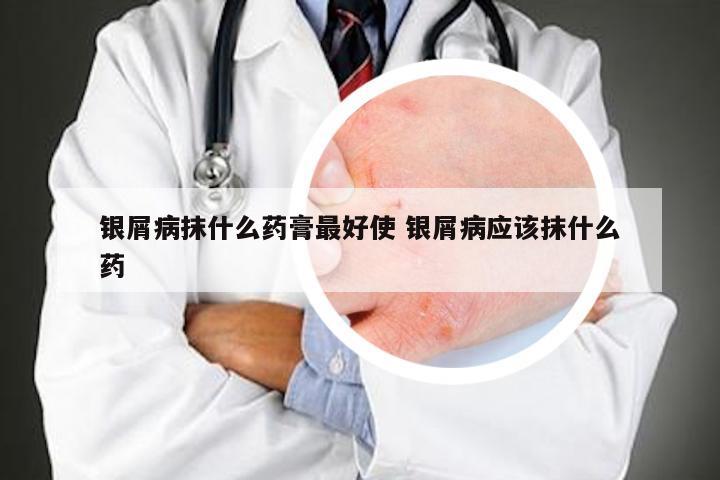 银屑病抹什么药膏最好使 银屑病应该抹什么药
