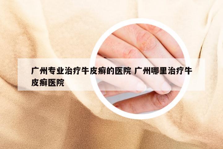 广州专业治疗牛皮癣的医院 广州哪里治疗牛皮癣医院