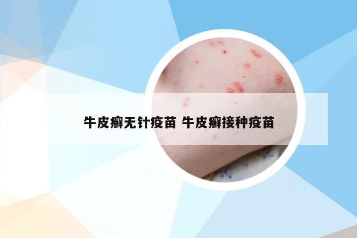 牛皮癣无针疫苗 牛皮癣接种疫苗