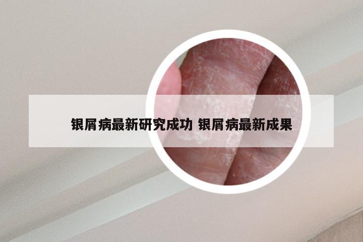 银屑病最新研究成功 银屑病最新成果