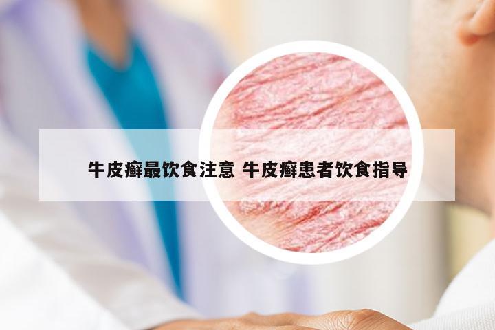 牛皮癣最饮食注意 牛皮癣患者饮食指导