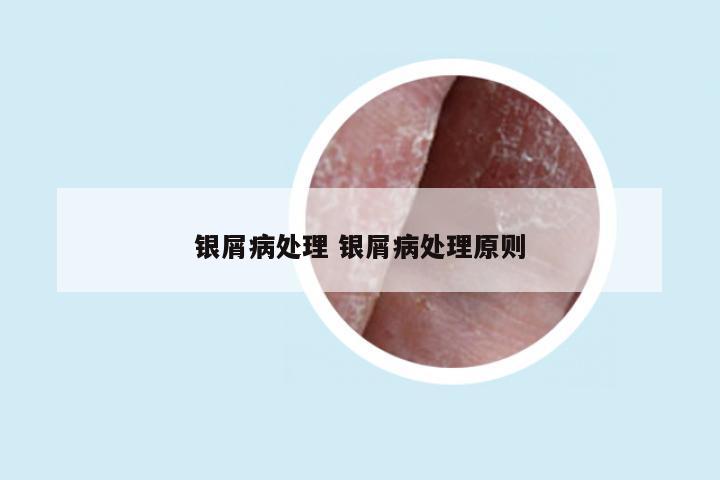银屑病处理 银屑病处理原则