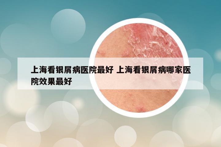 上海看银屑病医院最好 上海看银屑病哪家医院效果最好