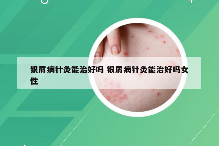 银屑病针灸能治好吗 银屑病针灸能治好吗女性