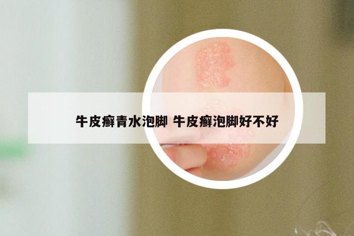 牛皮癣青水泡脚 牛皮癣泡脚好不好